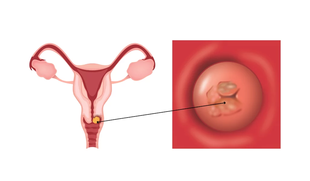 rak szyjki macicy gdzie się znajduje