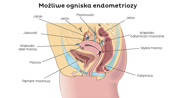 Endometrioza kobieca choroba nietypowe ogniska choroby